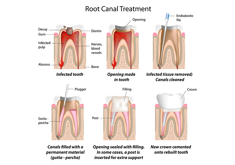 Root Canal Procedures