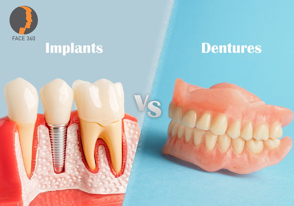 Implants v/s Dentures enn