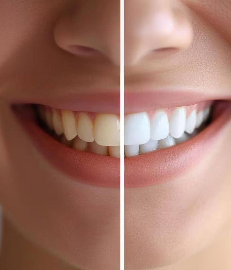 Before and after tooth whitening